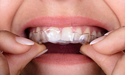 invisalign